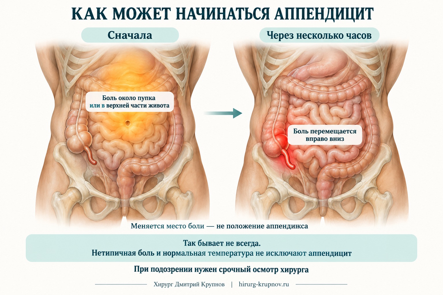 «Классическое начало аппендицита: боль около пупка или в верхней части живота с последующим перемещением вправо вниз».
