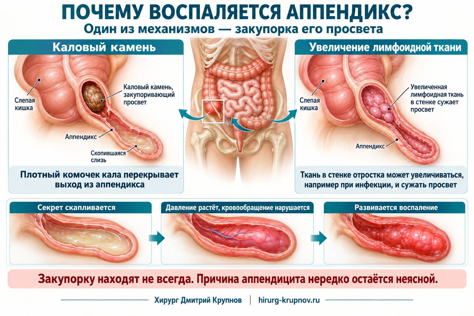 ричины аппендицита: закупорка просвета каловым камнем или увеличенной лимфоидной тканью и развитие воспаления