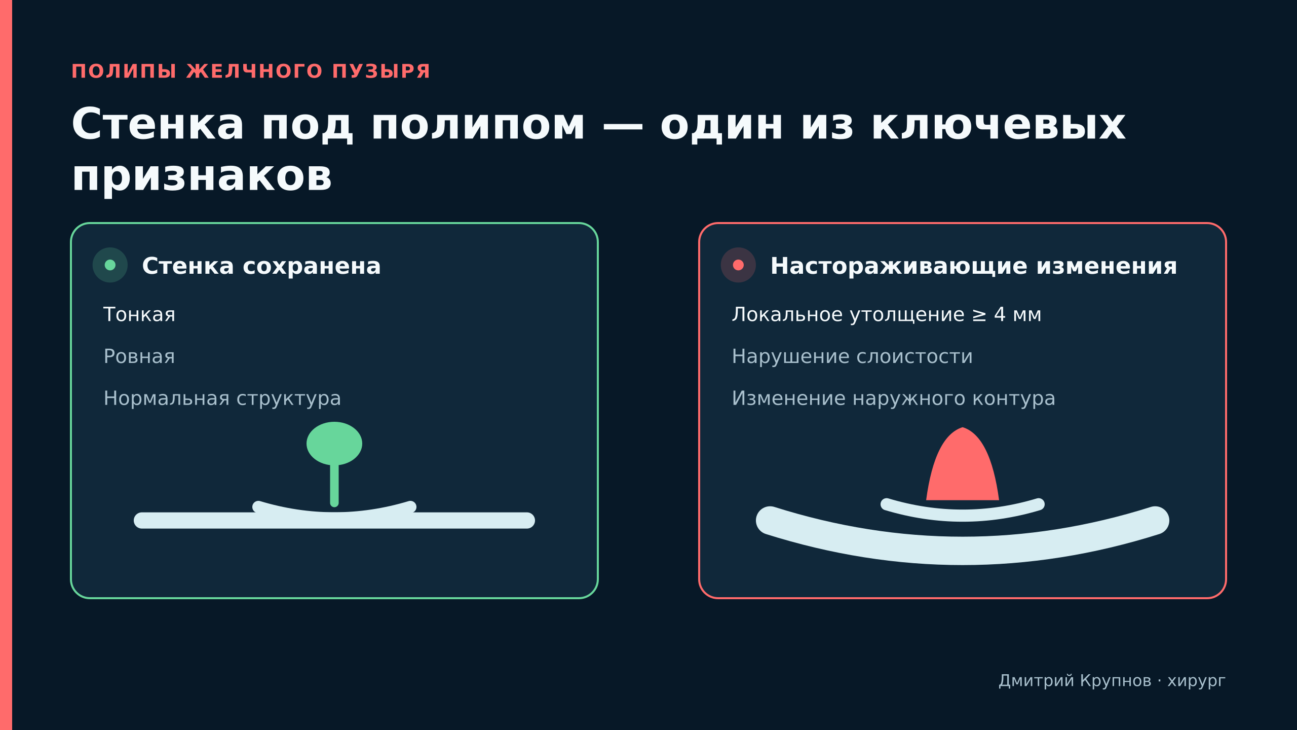 Полип при сохранённой и изменённой стенке желчного пузыря