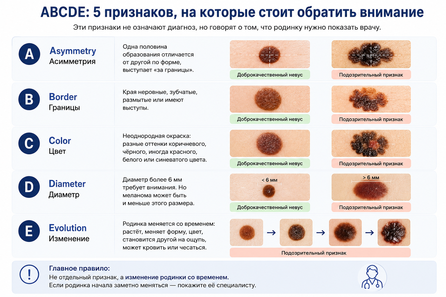 Правило ABCDE: признаки опасной родинки — асимметрия, неровные границы, неоднородный цвет, диаметр и изменение со временем