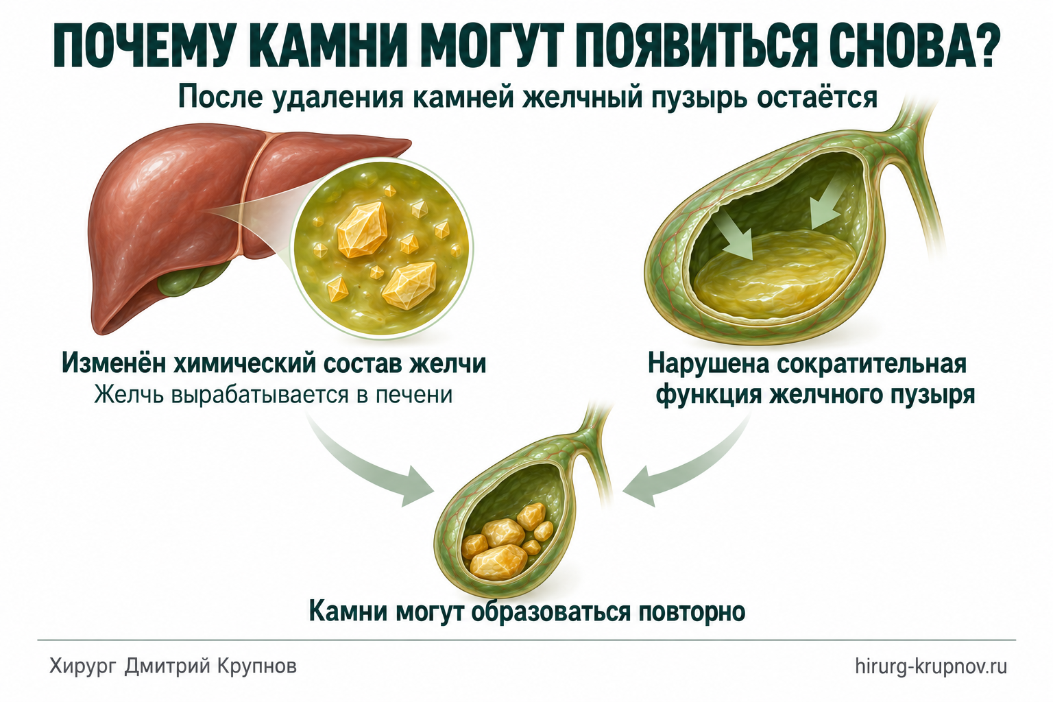Причины образования камней в желчном пузыре: нарушение сократительной функции желчного пузыря и изменение химического состава желчи