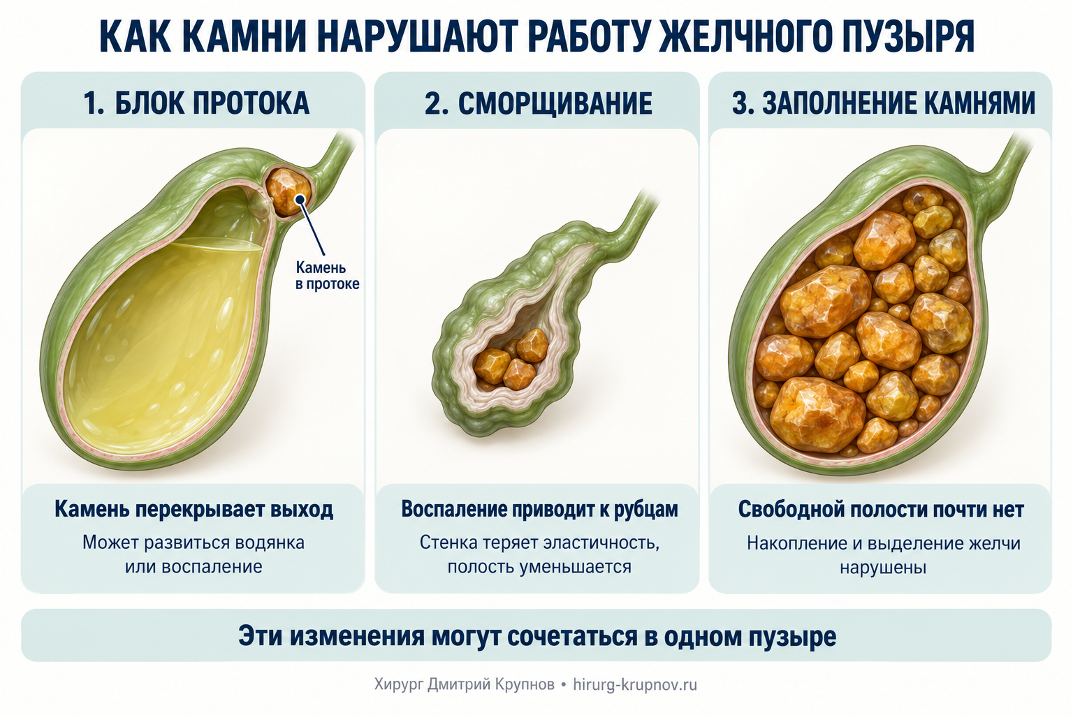 Наиболее частые причины отключенного желчного пузыря - камни