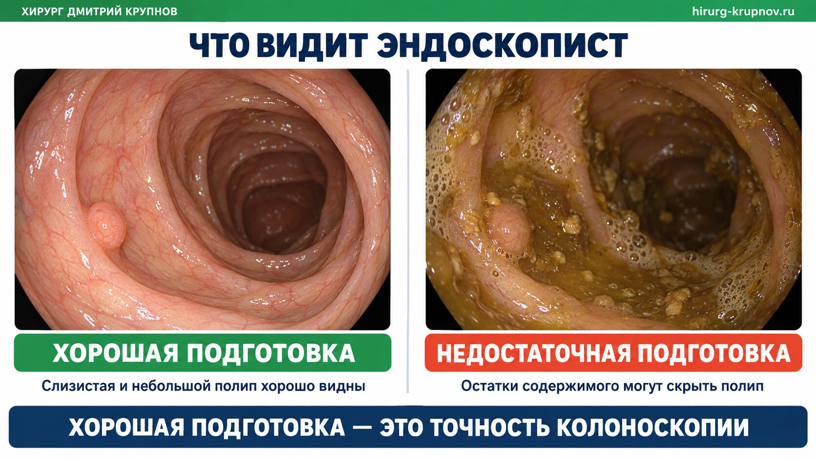 Хорошая и недостаточная подготовка кишечника к колоноскопии: видимость небольшого полипа при осмотре эндоскопистом.