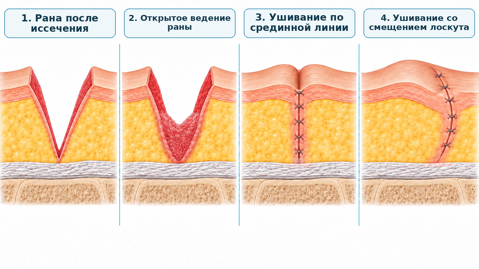 Эпителиальный копчиковый ход. Способы ведения раны: с ушиванием и без ушивания