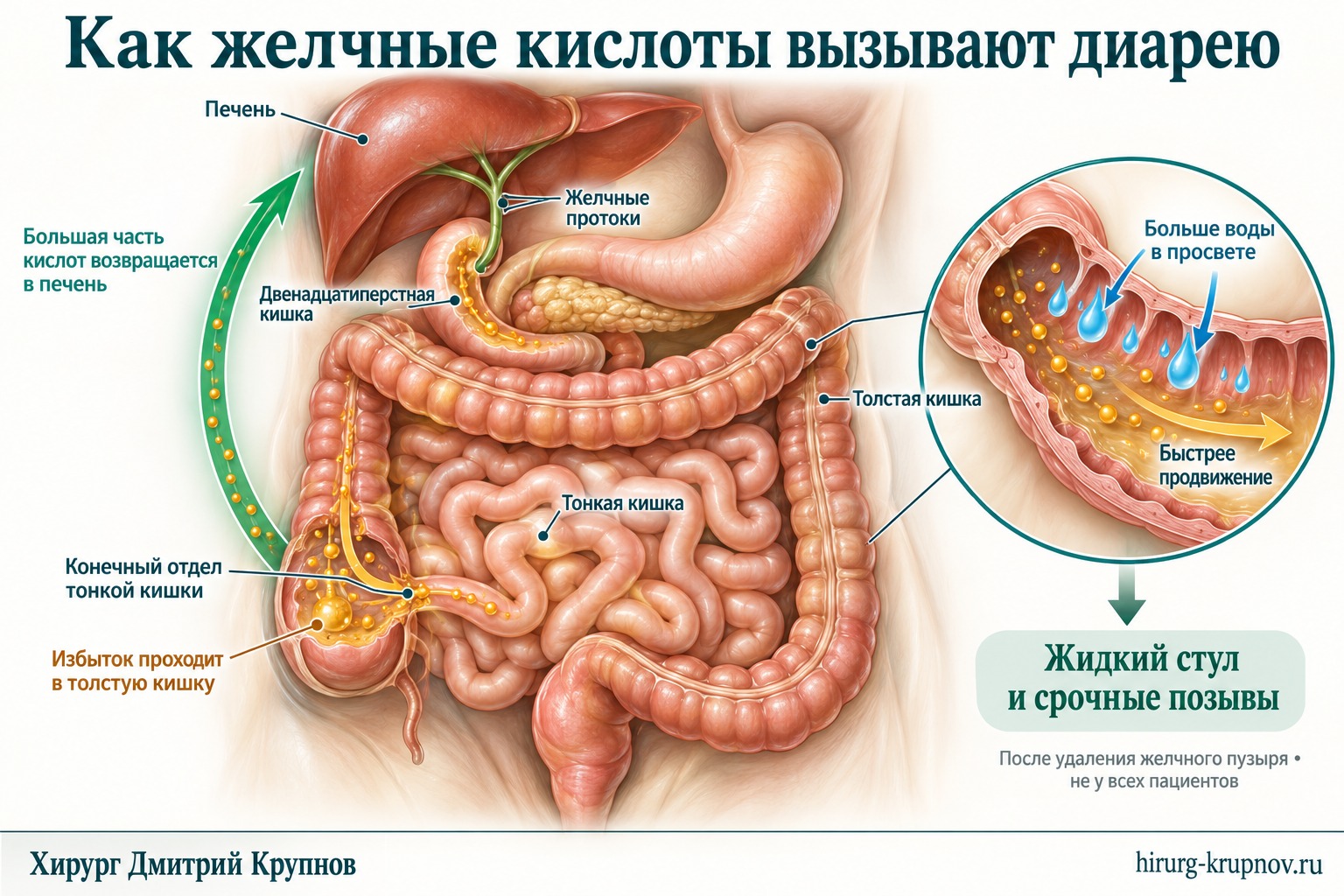 диарея после удаления желчного пузыря
