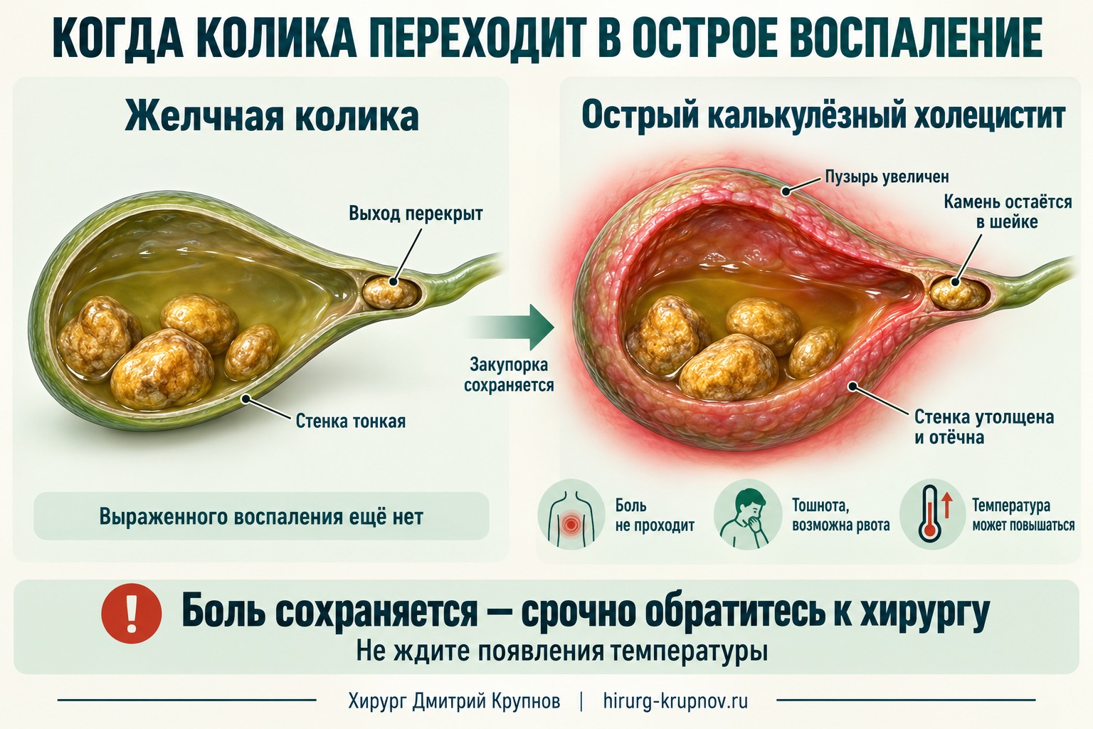 Желчная колика и острый калькулёзный холецистит: при сохраняющейся закупорке камнем в шейке желчный пузырь увеличивается, его стенка утолщается и воспаляется.