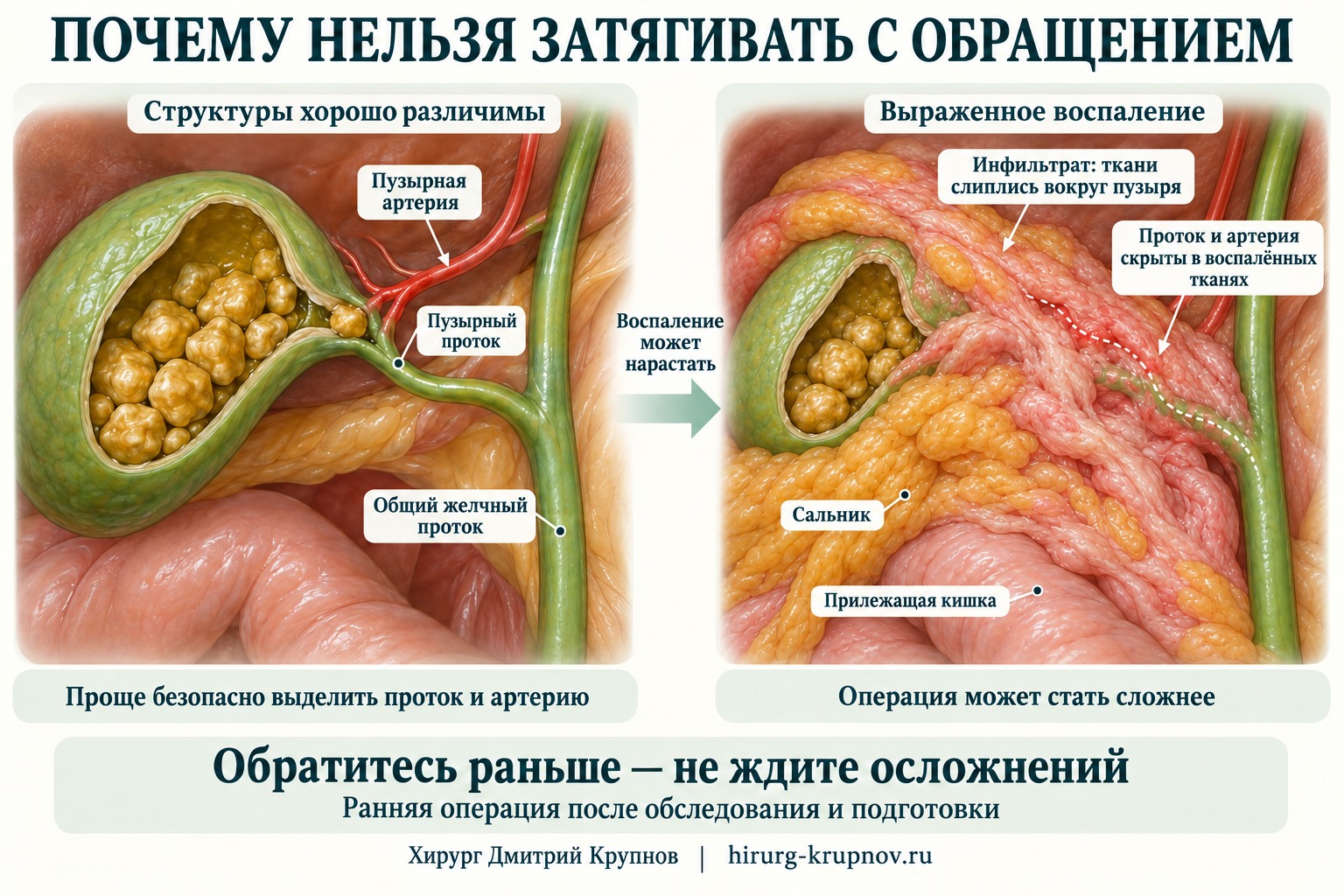 Перипузырный воспалительный инфильтрат: сальник и прилежащая кишка соединяются с воспалёнными тканями вокруг желчного пузыря, затрудняя выделение пузырного протока и артерии.