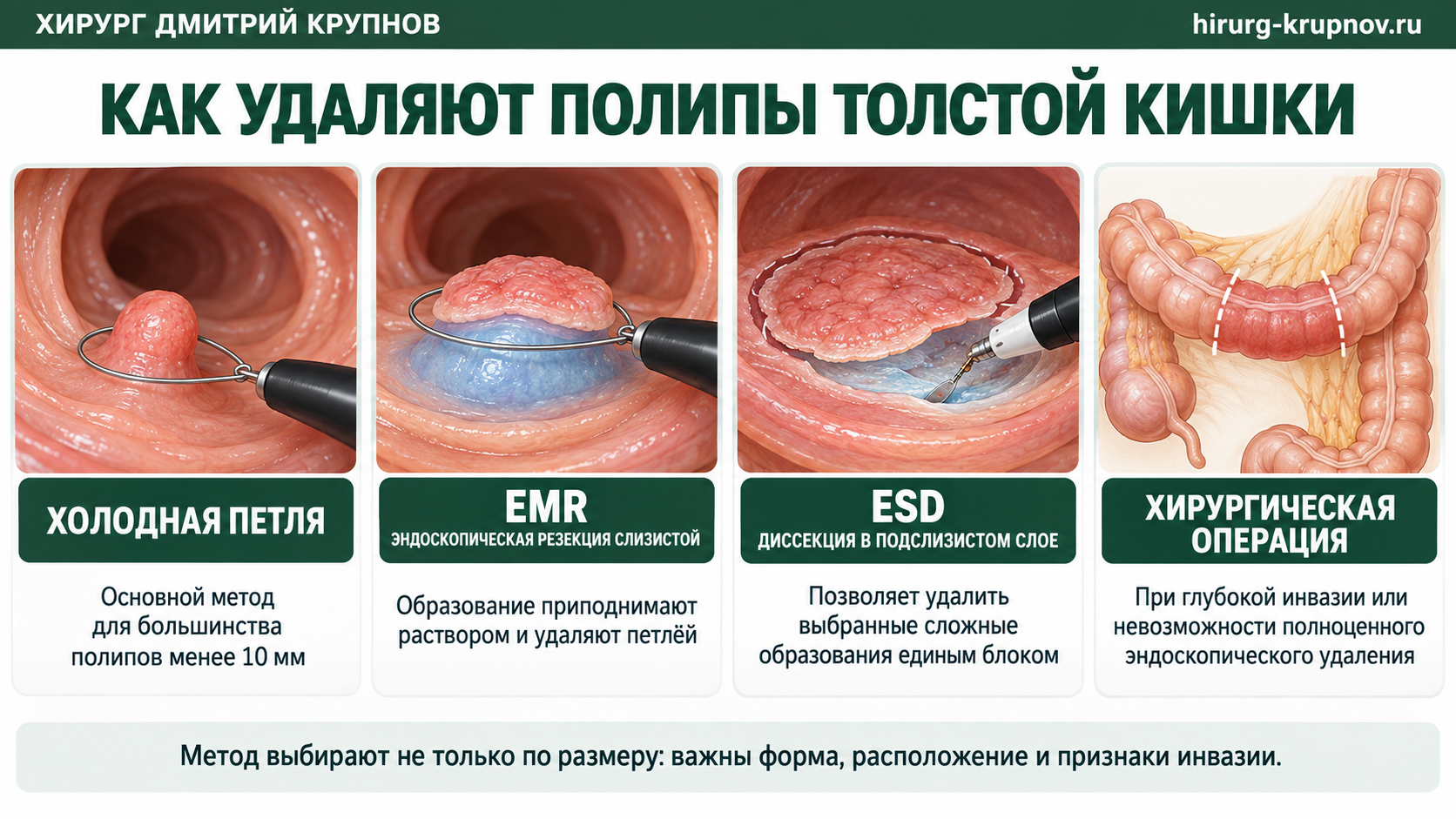 Холодная петля, EMR, ESD, и хирургическая операция при полипах толстой кишки