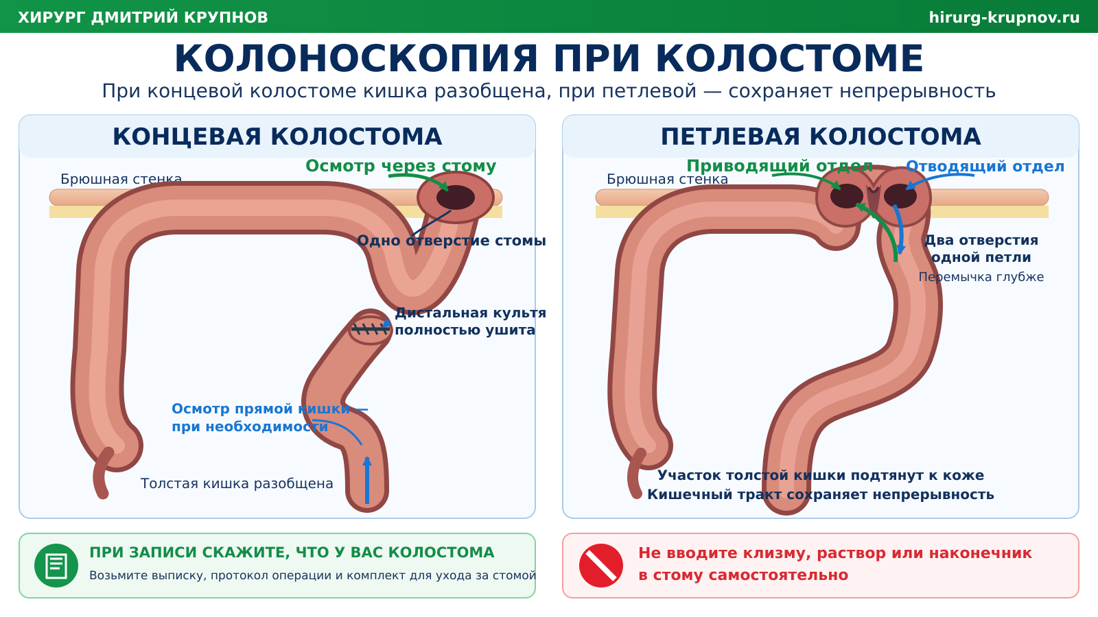Колоноскопия при концевой и петлевой колостоме: строение стомы и возможные пути эндоскопического осмотра