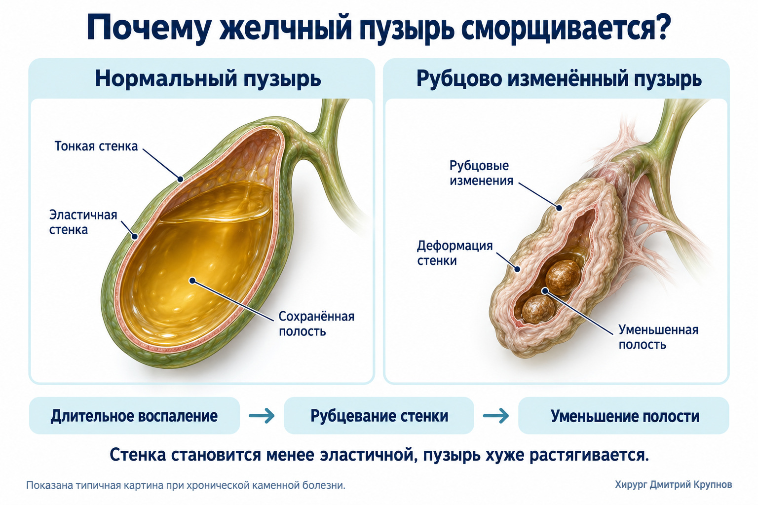 Почему желчный пузырь превращается в сморщенный