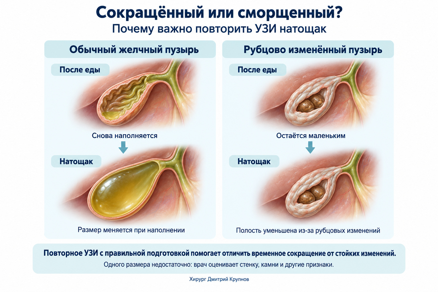 как отличить сморщенный желчный пузырь от обычного на УЗИ